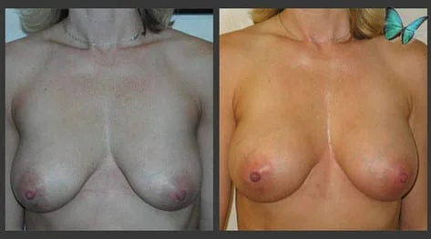 Breast Augmentation before and after photos by leading Los Angeles Plastic Surgeon in Beverly Hills Dr. Malcolm Lesavoy.
