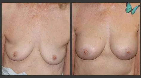 Breast Augmentation before and after photos by leading Los Angeles Plastic Surgeon in Beverly Hills Dr. Malcolm Lesavoy.