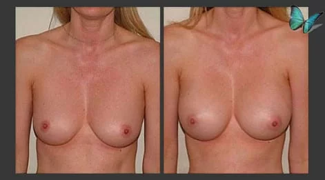Breast Augmentation before and after photos by leading Los Angeles Plastic Surgeon in Beverly Hills Dr. Malcolm Lesavoy.