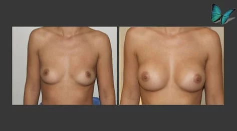 Breast Augmentation before and after photos by leading Los Angeles Plastic Surgeon in Beverly Hills Dr. Malcolm Lesavoy.