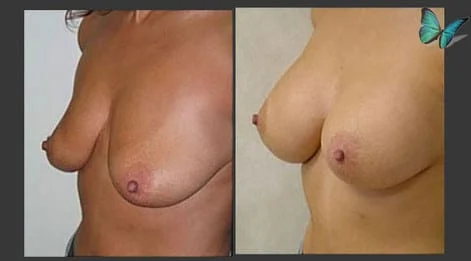 Breast Augmentation before and after photos by leading Los Angeles Plastic Surgeon in Beverly Hills Dr. Malcolm Lesavoy.