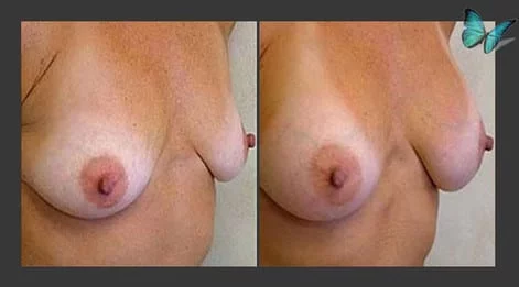Breast Augmentation before and after photos by leading Los Angeles Plastic Surgeon in Beverly Hills Dr. Malcolm Lesavoy.