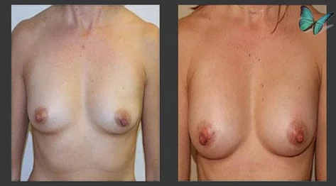 Breast Augmentation with Armpit Incision Before and After by Leading Los Angeles Plastic Surgeon in Beverly Hills Dr. Malcolm Lesavoy.