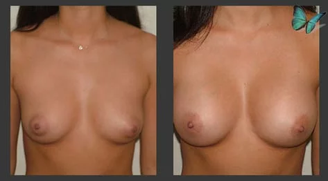 Breast Augmentation with Armpit Incision Before and After by Leading Los Angeles Plastic Surgeon in Beverly Hills Dr. Malcolm Lesavoy.