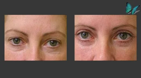 Eyelid Surgery Before and After by Beverly Hills Facial Plastic Surgery Specialist Dr. Malcolm Lesavoy.