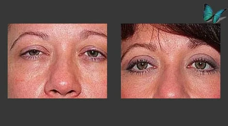 Eyelid Surgery Before and After by Beverly Hills Facial Plastic Surgery Specialist Dr. Malcolm Lesavoy.