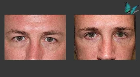 Eyelid Surgery Before and After by Beverly Hills Facial Plastic Surgery Specialist Dr. Malcolm Lesavoy.