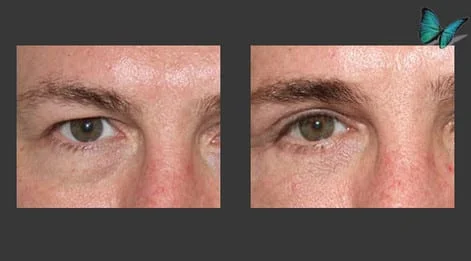 Eyelid Surgery Before and After by Beverly Hills Facial Plastic Surgery Specialist Dr. Malcolm Lesavoy.