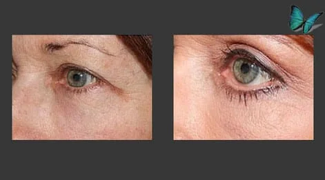 Eyelid Surgery Before and After by Beverly Hills Facial Plastic Surgery Specialist Dr. Malcolm Lesavoy.