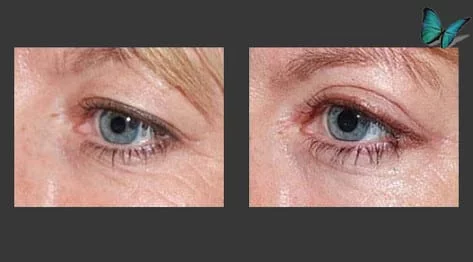 Eyelid Surgery Before and After by Best Beverly Hills Facial Plastic Surgery Specialist Dr. Malcolm Lesavoy.