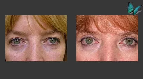 Eyelid Surgery Before and After by Best Beverly Hills Facial Plastic Surgery Specialist Dr. Malcolm Lesavoy.