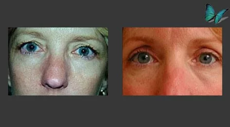 Eyelid Surgery Before and After by Beverly Hills Facial Plastic Surgery Specialist Dr. Malcolm Lesavoy.