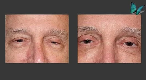 Eyelid Surgery Before and After by Beverly Hills Facial Plastic Surgery Specialist Dr. Malcolm Lesavoy.