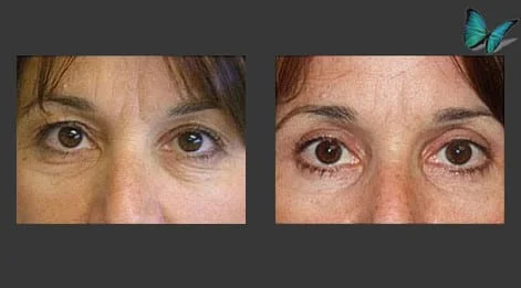 Eyelid Surgery Before and After by Beverly Hills Facial Plastic Surgery Specialist Dr. Malcolm Lesavoy.