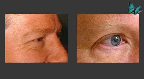 Eyelid Surgery Before and After by Beverly Hills Facial Plastic Surgery Specialist Dr. Malcolm Lesavoy.