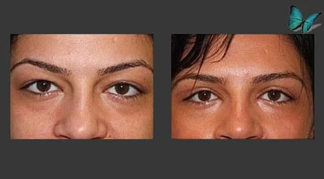 Eyelid Surgery Before and After by Beverly Hills Facial Plastic Surgery Specialist Dr. Malcolm Lesavoy.