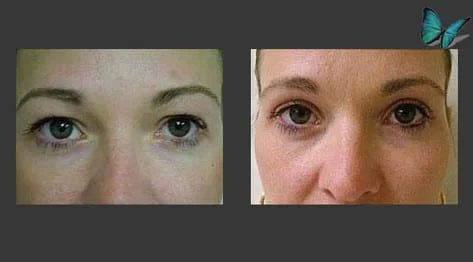 Eyelid Surgery Before and After by Best Beverly Hills Facial Plastic Surgery Specialist Dr. Malcolm Lesavoy.
