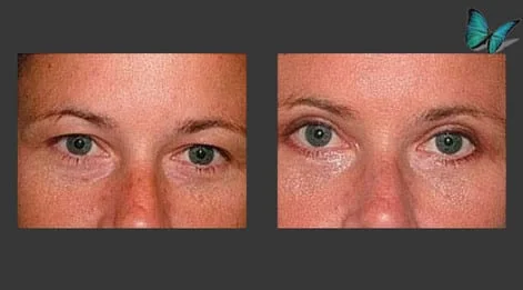 Eyelid Surgery Before and After by Beverly Hills Facial Plastic Surgery Specialist Dr. Malcolm Lesavoy.