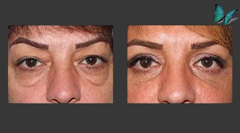 Eyelid Surgery Before and After by Best Beverly Hills Facial Plastic Surgery Specialist Dr. Malcolm Lesavoy.