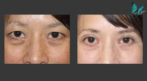 Eyelid Surgery Before and After by Beverly Hills Facial Plastic Surgery Specialist Dr. Malcolm Lesavoy.