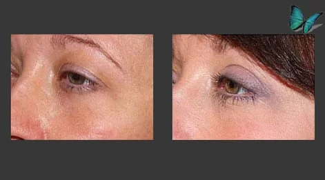 Eyelid Surgery Before and After by Beverly Hills Facial Plastic Surgery Specialist Dr. Malcolm Lesavoy.