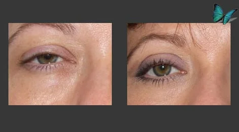 Eyelid Surgery Before and After by Beverly Hills Plastic Surgery Specialist Dr. Malcolm Lesavoy.