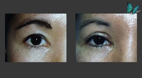 Eyelid Surgery Before and After by Best Beverly Hills Plastic Surgery Specialist Dr. Malcolm Lesavoy.