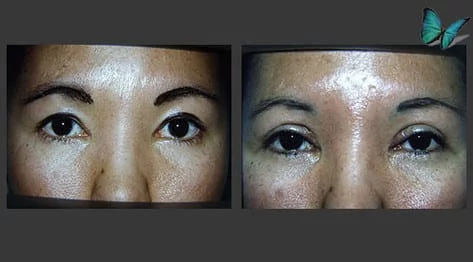 Eyelid Surgery Before and After by Beverly Hills Plastic Surgery Specialist Dr. Malcolm Lesavoy.