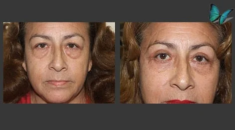 Eyelid Surgery Before and After by Beverly Hills Plastic Surgery Specialist Dr. Malcolm Lesavoy.