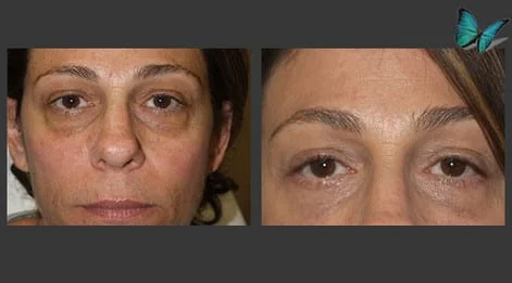 Eyelid Surgery Before and After by Beverly Hills Plastic Surgery Specialist Dr. Malcolm Lesavoy.