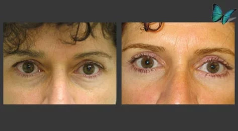 Eyelid Surgery Before and After by Beverly Hills Plastic Surgery Specialist Dr. Malcolm Lesavoy.