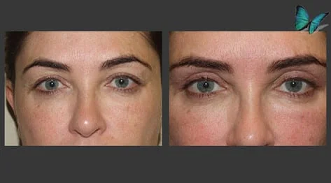 Eyelid Surgery Before and After by Beverly Hills Plastic Surgery Specialist Dr. Malcolm Lesavoy.