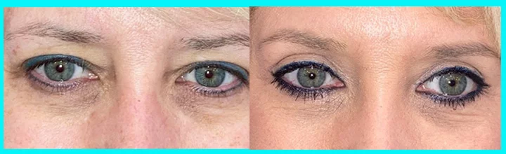 Before and after upper and lower eyelid surgery of a female patient. Before and after upper and lower eyelid surgery of a female patient.