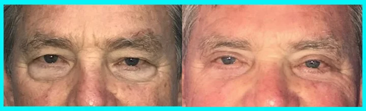 Upper and lower eyelid surgery of a male patient. Upper and lower eyelid surgery of a male patient.