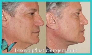 Before and After Photos of a male neck lift patient performed by Dr. Malcolm Lesavoy.