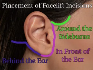 Photo illustrating the placement of facelift scars. Photo used courtesy of Faceliftology.com