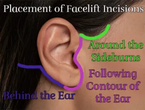 Photo illustrating the placement of facelift scars. Photo used courtesy of Faceliftology.com