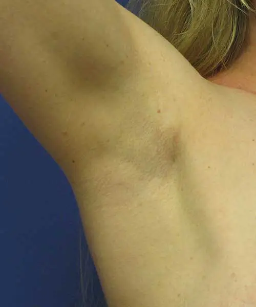 armpitincisionforbreastimplants Photo shows armpit scarring with armpit breast implants by Los Angeles Plastic Surgeon Dr. Malcolm Lesavoy