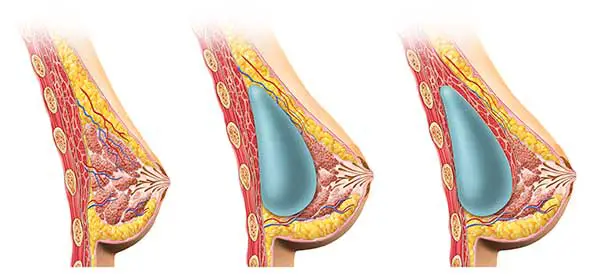 Breast Augmentation Beverly Hills Los Angeles
