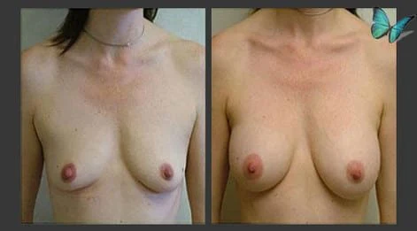 Before and after photos of breast augmentation with natural-looking results