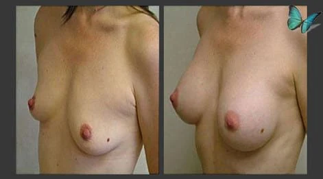 Before and after photos of breast augmentation with natural-looking results