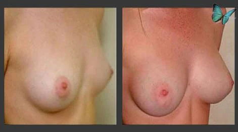 Breast augmentation before and after with fuller upper pole and balanced proportions