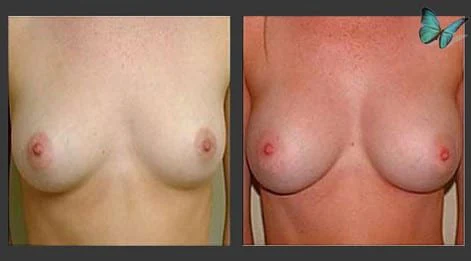 Before and after breast augmentation demonstrating enhanced breast shape