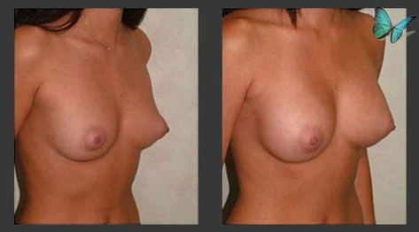Breast augmentation before and after with fuller upper pole and balanced proportions