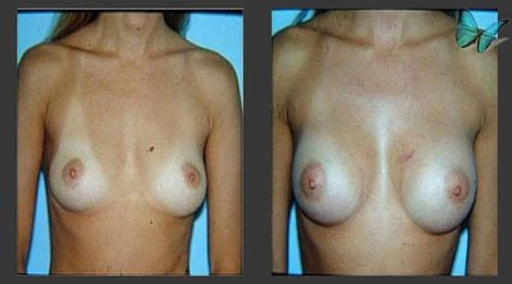 Breast augmentation before and after with fuller upper pole and balanced proportions