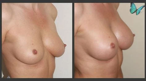 Breast augmentation before and after with fuller upper pole and balanced proportions