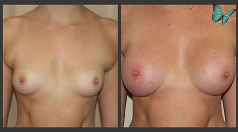 Before and after breast augmentation demonstrating enhanced breast shape