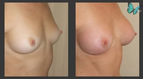 Before and after breast augmentation demonstrating enhanced breast shape