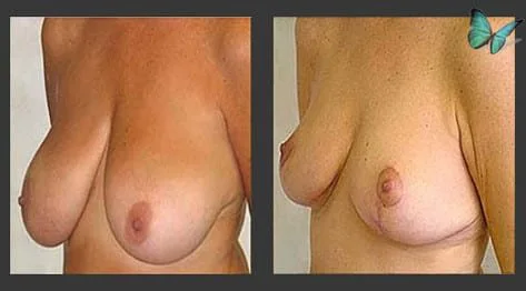 Breast lift results correcting sagging and restoring youthful contour