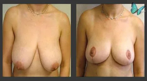 Breast lift with reduction results correcting heaviness and sagging